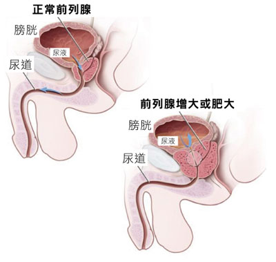 前列腺增生术后会引起性功能障碍吗？